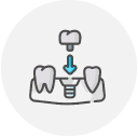 Implantes dentales